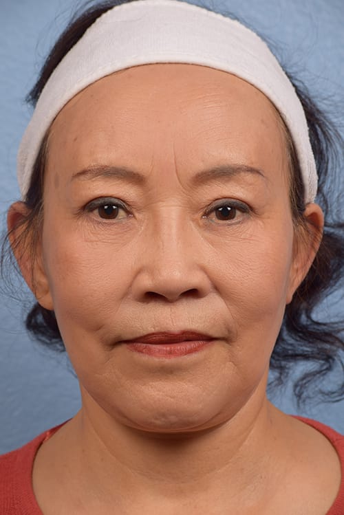 Forehead Lift Before And After Cheng Plastic Surgery 